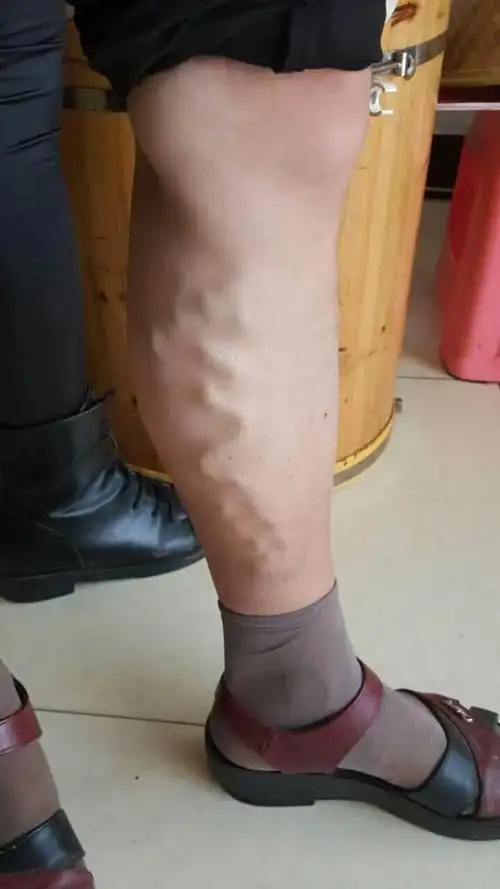 路染的小腿分享我静脉曲张的治疗历程