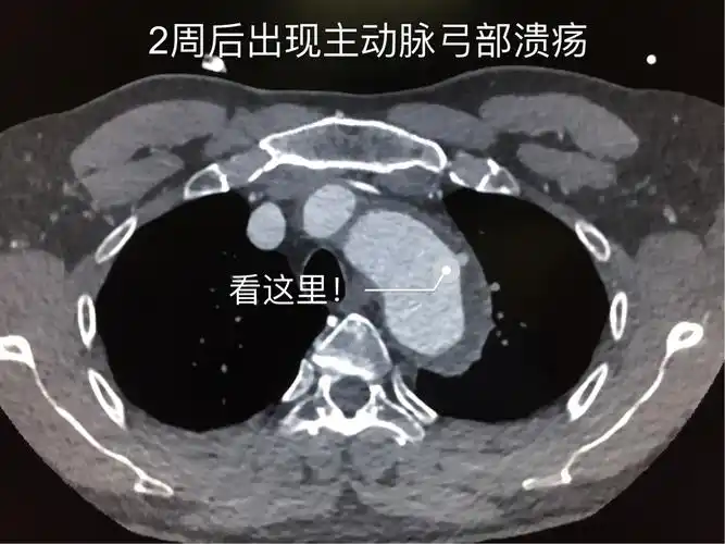 2周之后复查胸部cta,提示主动脉弓降部的一个小溃疡.