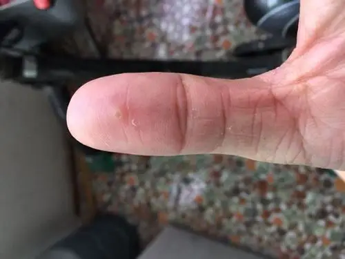 手上的跖疣图片