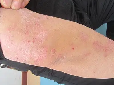 最新动态_济南银屑病医院_中华康网