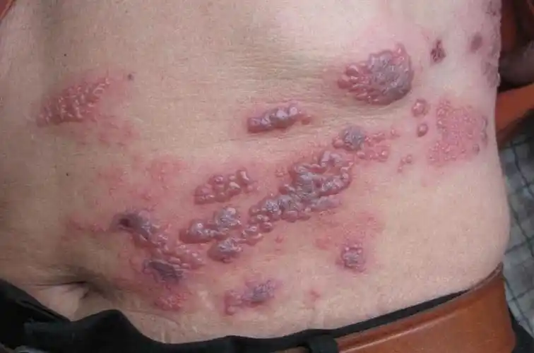 超痛的皮肤病带状疱疹