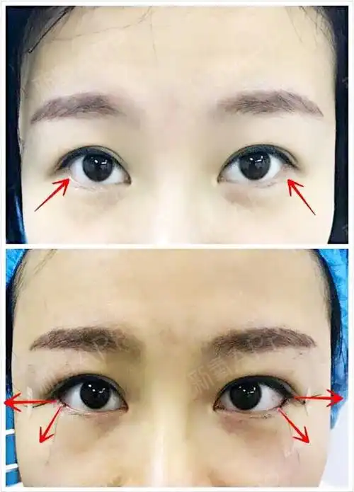 我的外眼角和下至手术,都说做得好,我也感觉眼睛大点_圈子-新氧美容
