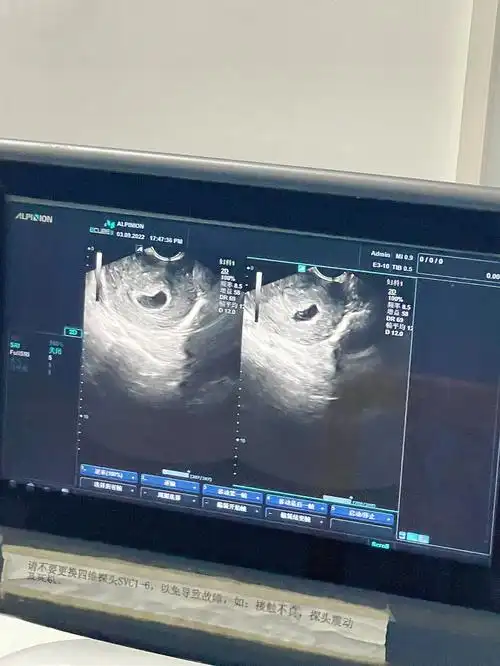 7215怀疑葡萄胎或者绒癌98不要吓我