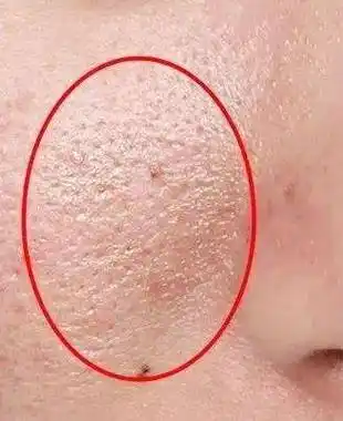 毛孔粗大怎么办单靠护肤真的有用吗