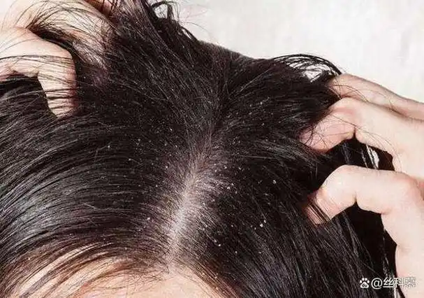 头发爱出油,不仅容易让头发看起来油腻腻的,还会让人感觉整个人都不