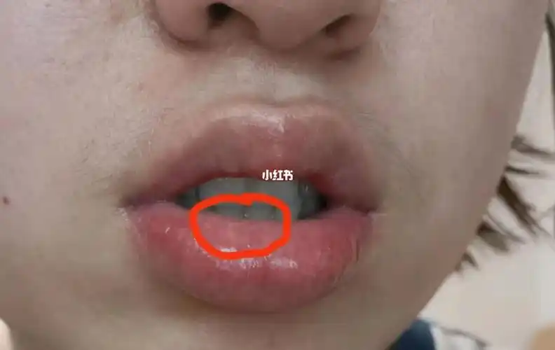 呃可能都不一定是唇炎的嘴唇治疗进度3