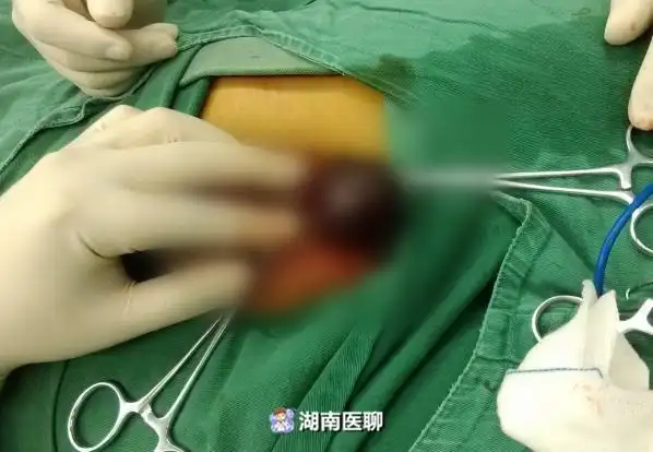 当心"蛋蛋"扭转!延误治疗或致切除_睾丸