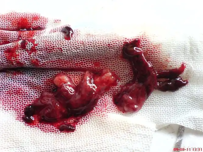 如何        月经期  月经周期  子宫肌瘤