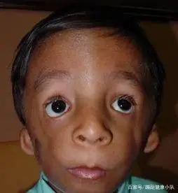 又是一名罕见病患者,她的这种病因为颧骨和下颌骨发育不全,小耳畸形