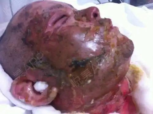 对于复合组织缺损的面部烧伤患者,如耳,眼睑,鼻,口唇等伴有软骨粘膜的