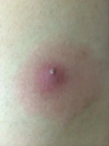 腿上长了个包,有痛感,求解