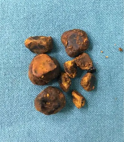 认识胆总管结石 - 春雨医生