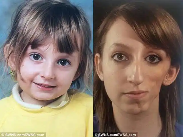 女孩患罕见病一半的脸萎缩,全世界不到1000例