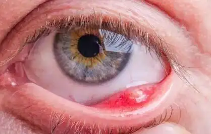 麦粒肿是什么原因引起(麦粒肿是什么原因引起)-女性资讯网