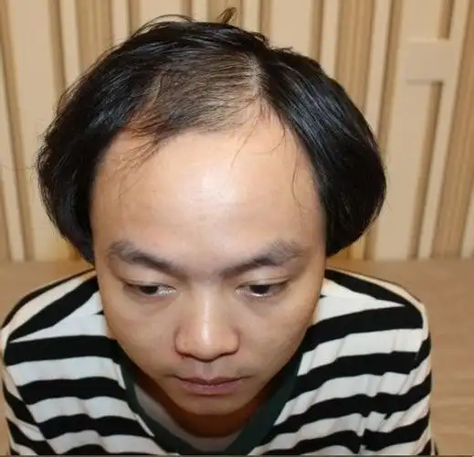 张先生就是一个典范,平时压力大,作息不规律,年纪轻轻就开始秃顶了