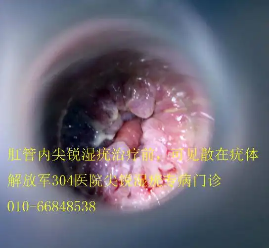 肛管内尖锐湿疣治疗前后照片可以转载