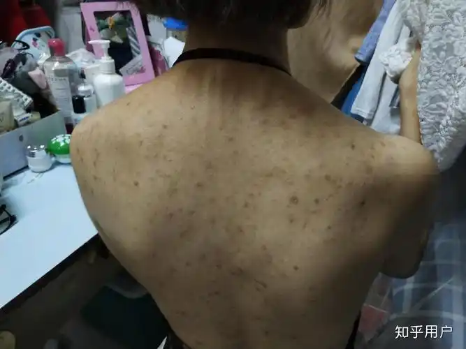 背上的毛囊炎有点严重