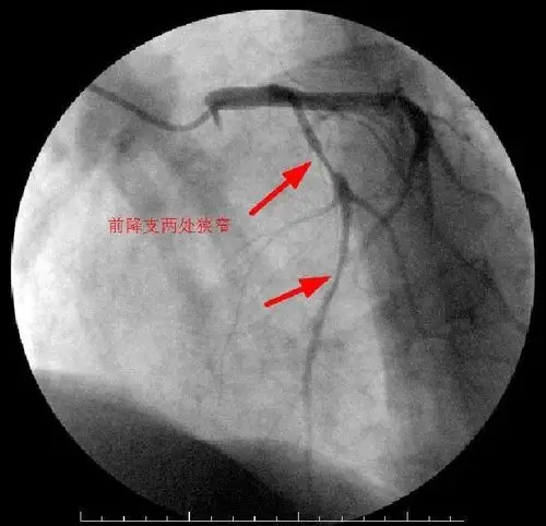 冠脉造影术——叶县二院介入科