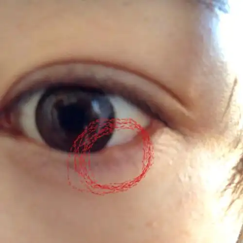 我最近几个月发现下眼睑里面长了个白色疙瘩 硬的 如图 我经常戴隐形