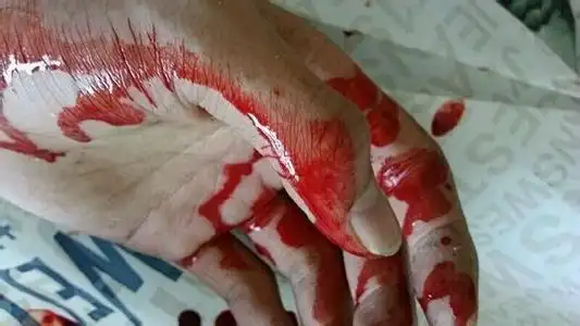 从杭州小伙求复合不成拿刀自残谈自残是什么心理疾病及心理分析