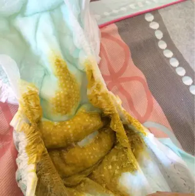 宝宝已经拉了俩个月这样的便便了,看了网上说吃纯母乳,便便应该是黄色
