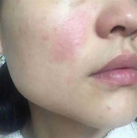 脸部过敏红肿如何消肿怎么处理