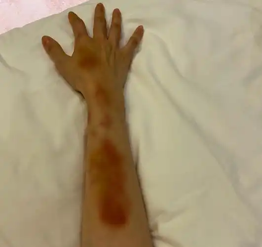 陈小纭射箭体操夺双冠当她晒出手臂的伤才知冠军有多来之不易