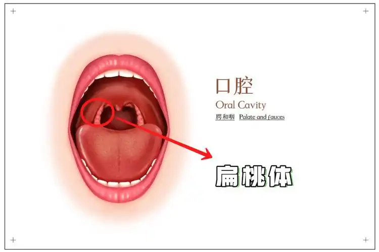 扁桃体反复发炎,肿大,孩子经常感冒,高烧不退!是割还是留?