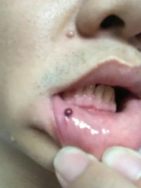 内唇起了个血泡,是怎么回事,现在在服虫草丸,前一阵子做了肾肿瘤切除