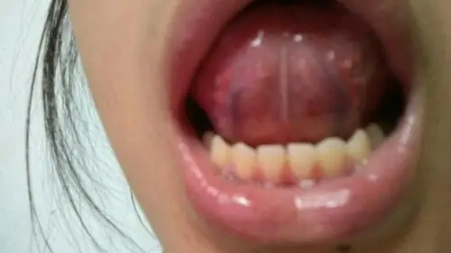 舌头背面这不知怎么非常疼刺痛的…接近牙齿地方的牙肉非常疼怎么回事