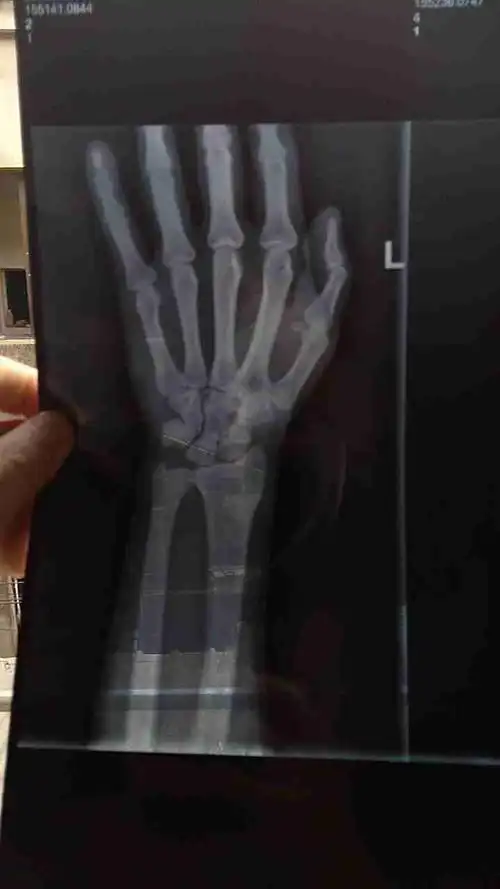 左手腕骨折多久能拆石膏