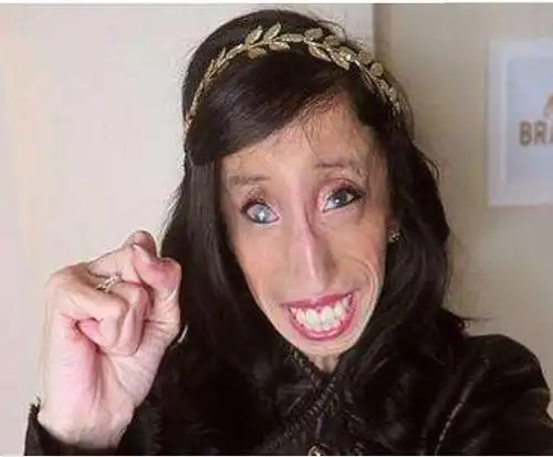 世界上最丑女人,丽兹·维拉斯奎兹(先天畸形/人虽丑但很励志)