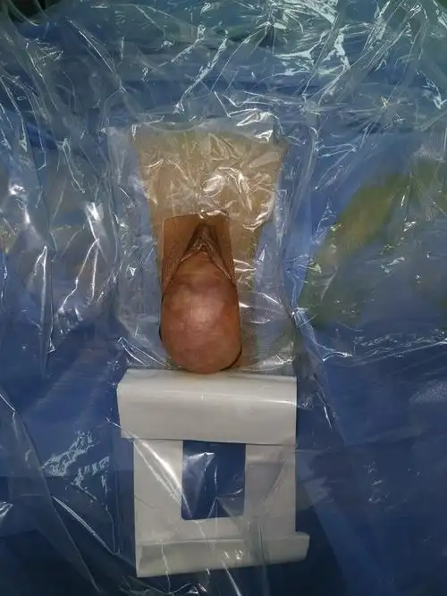 子宫脱垂的微创治疗 - 好大夫在线