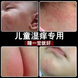 儿童婴幼儿宝宝湿疹膏红屁股口水疹红痱子专用止痒紫草膏婴宝药膏