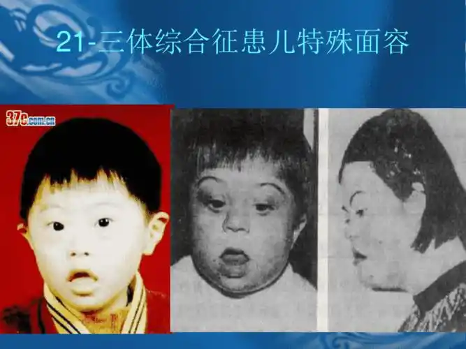 21三体综合征解析 ppt