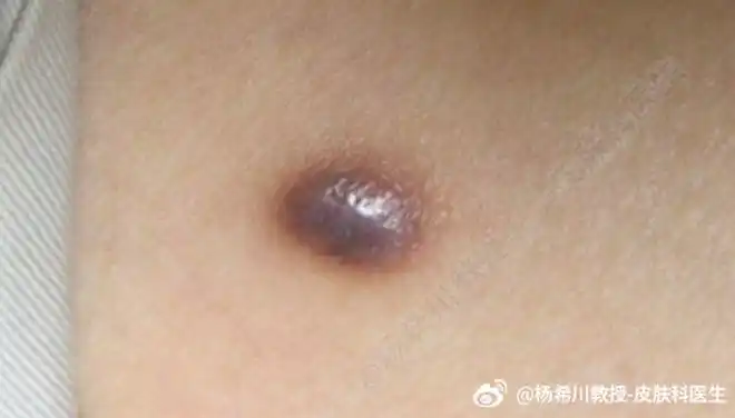 杨教授每周病例分享皮肤纤维瘤