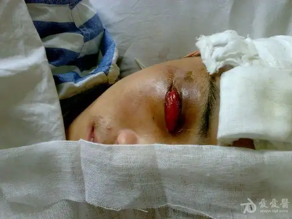 颅脑外伤后眼睑结膜囊水肿