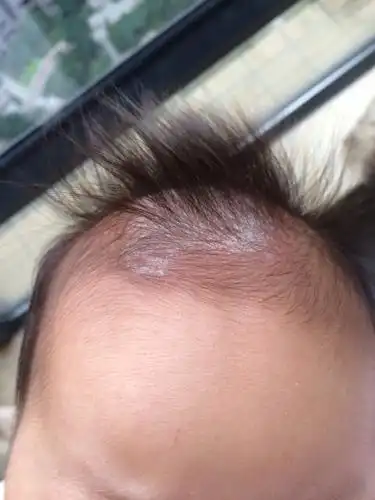 洗了头皮又红,该洗吗?