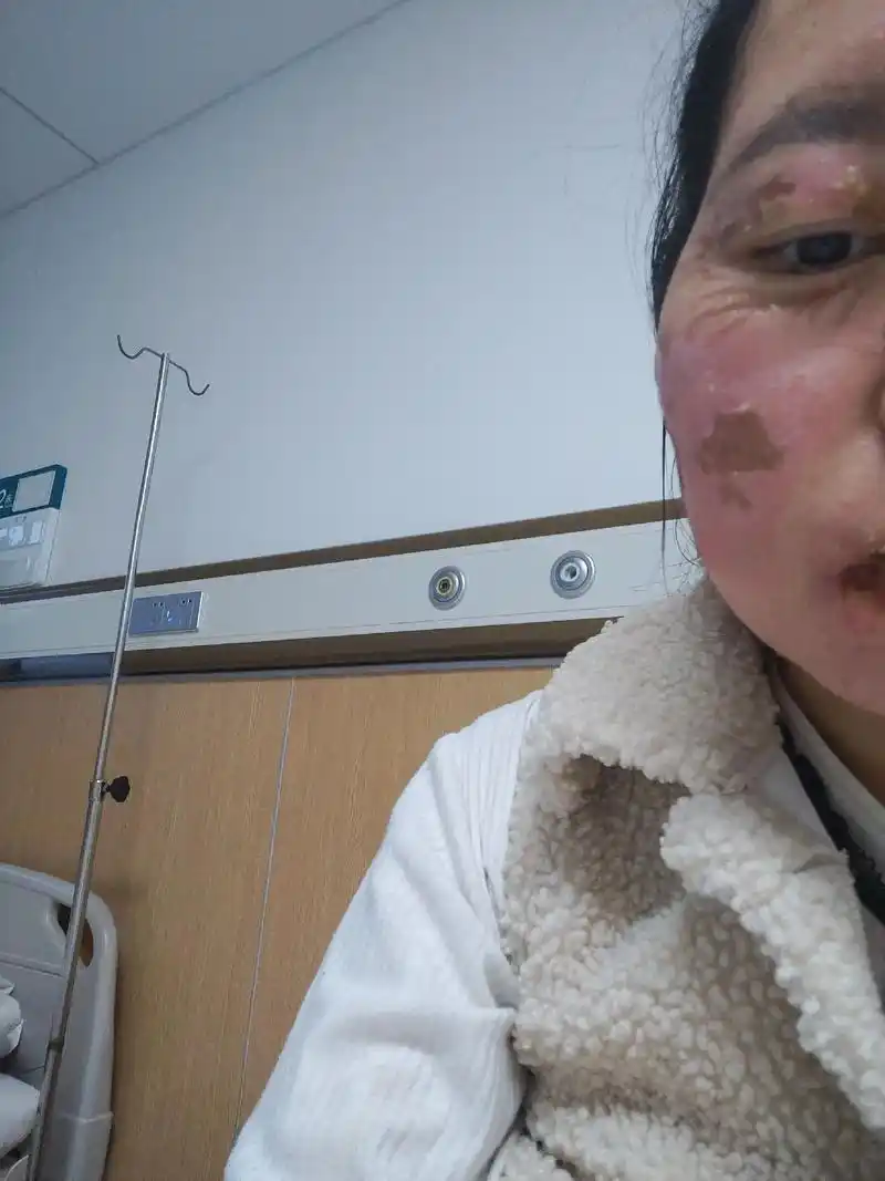 被烫伤的第十天,脸在恢复中,手也在慢慢的恢复,一切都往好的方 - 抖音