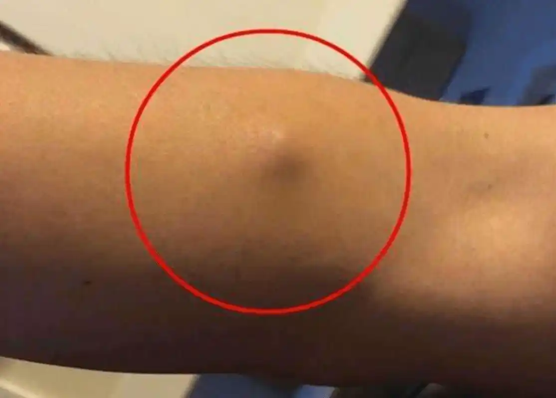 这些部位出现不明肿块就是癌吗教你简单分辨避免闹乌龙