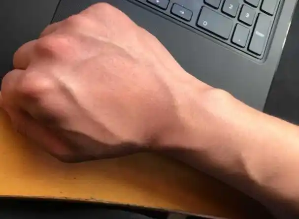 有的人手臂"青筋暴起",有的人几乎看不到青筋,哪种更健康呢?