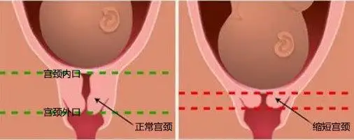 宫颈缩短怎么办?_产前检查_疾病介绍_介绍 - 好大夫在线
