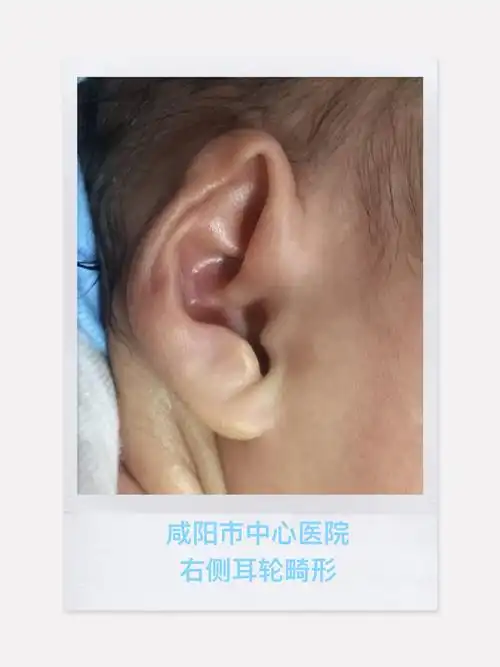 新生儿耳廓畸形科普(一)_耳部整形_治疗介绍_介绍_发病原因 - 好大夫