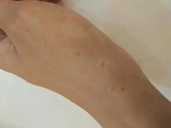 手腕处突然出现几个红点,不痛不痒,稍微用力挤按会消失松手后又会出现