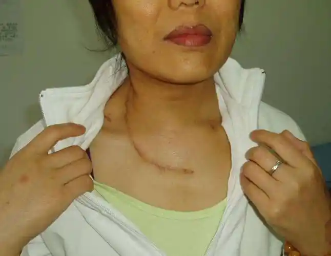 晚期甲状腺癌颈淋巴结清扫术切口的改进--颈锁骨下的大弧形切口 - 好