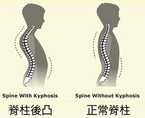 驼背不仅仅是肌肉问题更多问题在脊柱