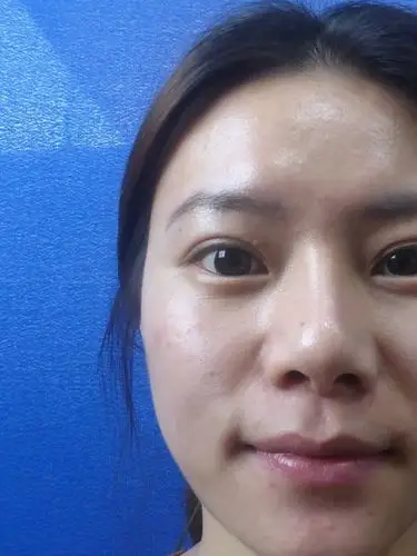 打的苹果肌和法令纹,本来就是亚洲人平脸挂不住肉显老_圈子-新氧美容