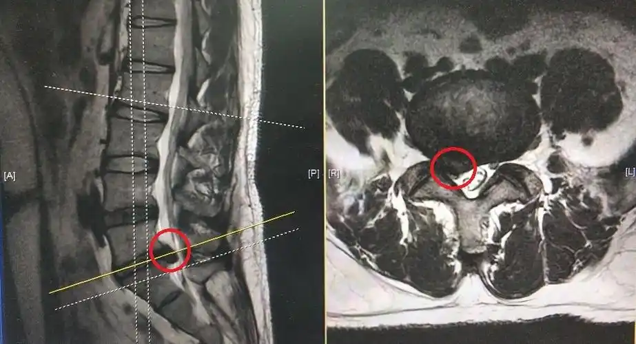 腰椎mri示:l5-s1椎间盘脱出并下游离,神经受压迫严重(下图中红色圈