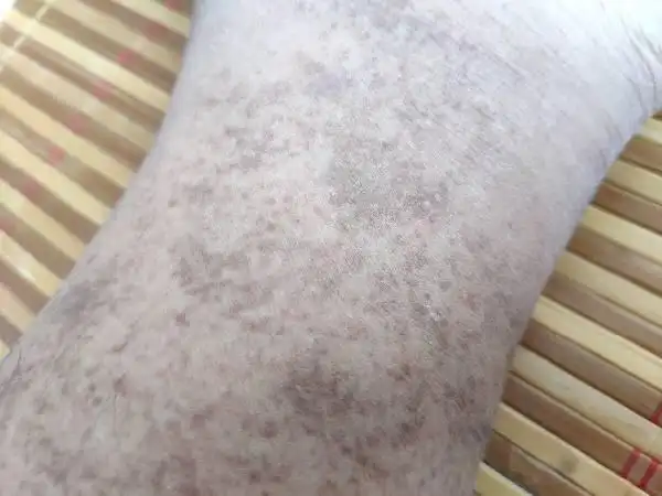 小腿出现血色斑点,怎么治疗