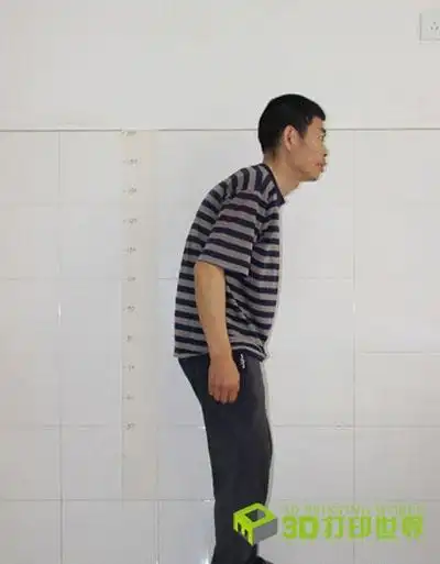 3d打印技术让驼背患者"直立行走"